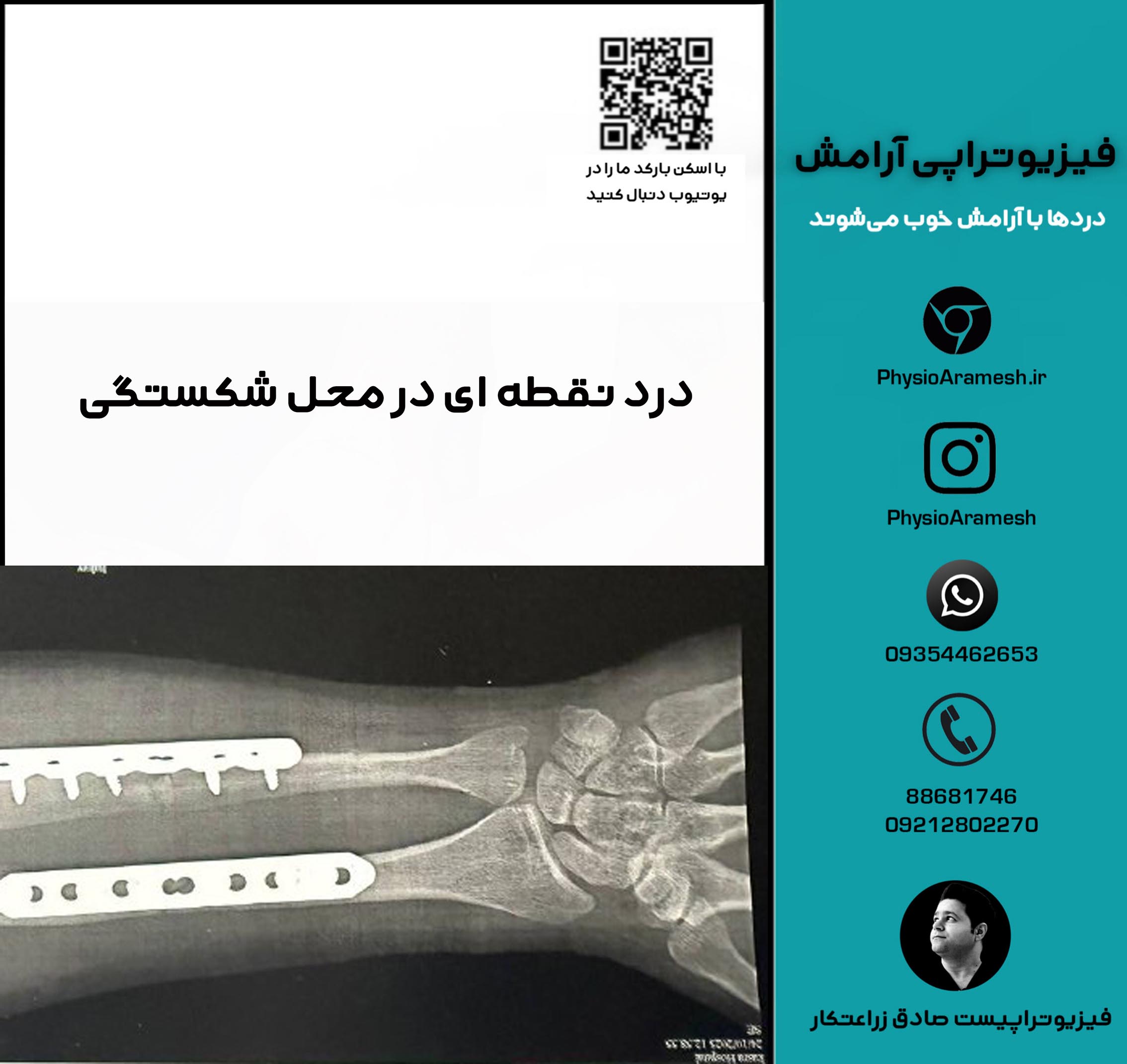 درد نقطه ای در محل شکستگی